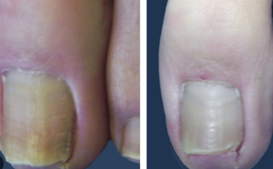 before and after nail fungus